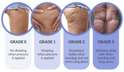 cellulite-image